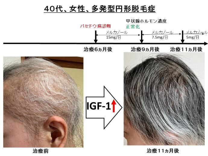 円形脱毛症　病院